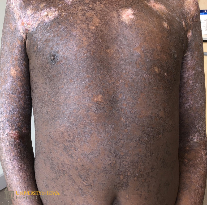 Global hyperpigmented reticulate scaly plaqaues with white sclertoic plaques on the upper chest and arms. (click images for higher resolution).